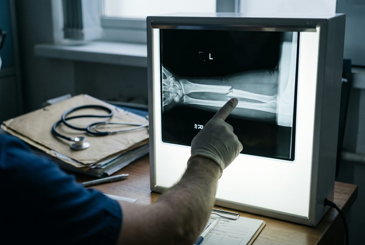X-ray of a human forearm clearly showing a clean transverse fracture of the radius bone on a backlit medical lightbox